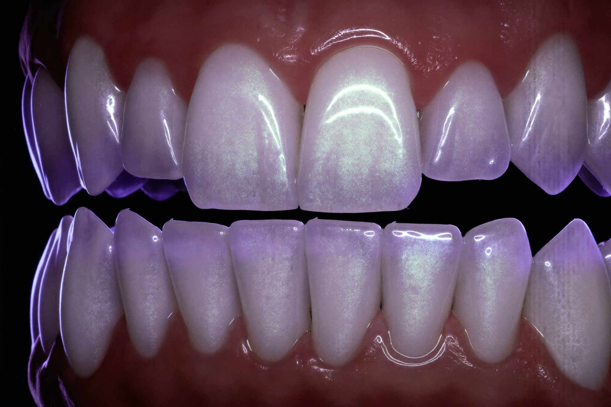 Enamel Strengthening